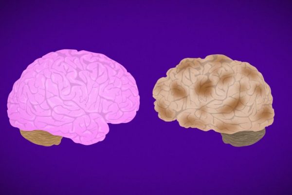 Alzheimer’s disease is a progressive brain disease that causes memory loss and other mental problems. Learn about the causes, symptoms, and treatment of Alzheimer’s disease.